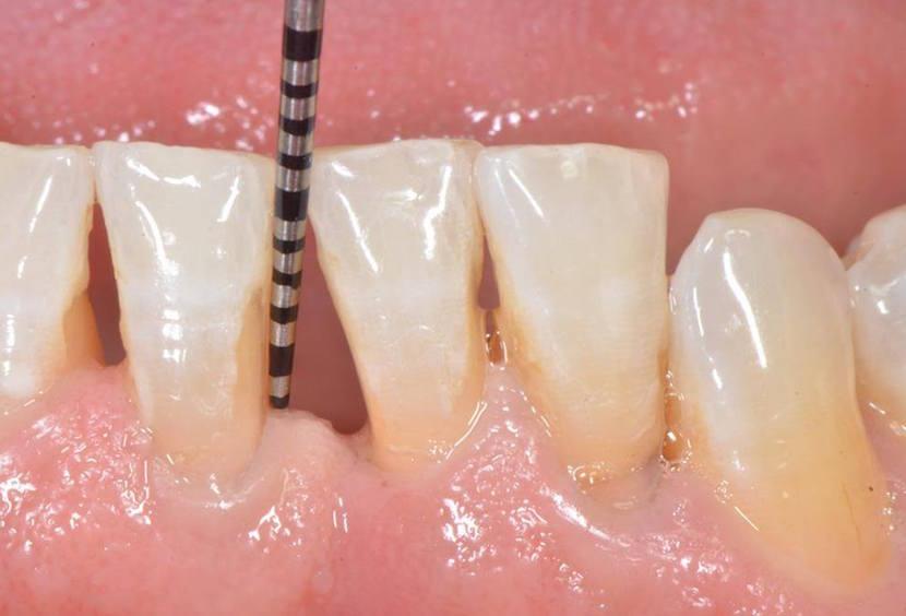 Discover effective solutions to tooth mobility