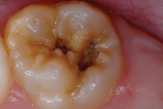 How to Prevent and Treat Dental Cavities