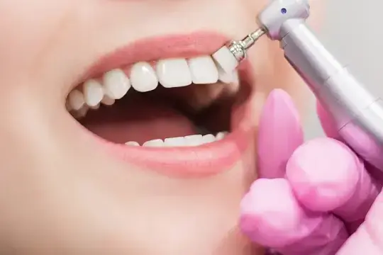 Professional Teeth Cleaning in Abuja: Why Scaling & Polishing is Essential for Healthy Smiles | Aster Smiles Dental Clinic Guzape