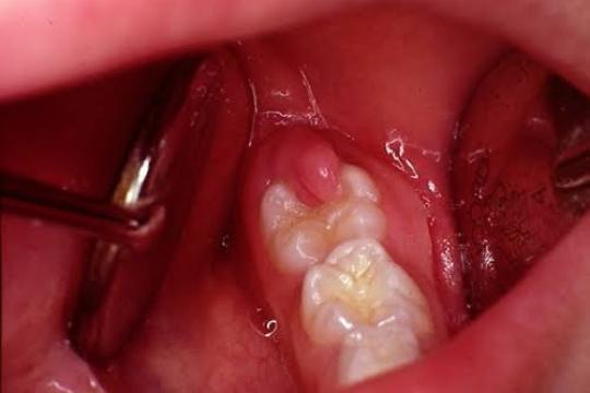 Dangers of Impacted Wisdom Teeth & Expert Treatment Options in Abuja | Aster Smiles
